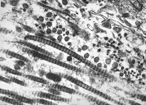 F, 45y. | necrobiosis lipoidica F, 45y. | necrobiosis lipoidica